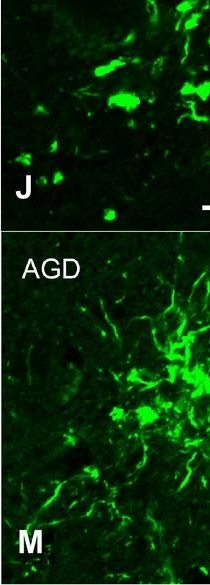 Factors associated with development and distribution of granular/fuzzy astrocytes in neurodegenerative diseases.