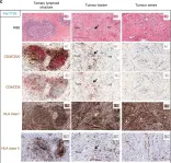 Fig.1.C showing Immunohistochemistry from the publication: Neoepitope targets of tumour-infiltrating lymphocytes from patients with pancreatic cancer.