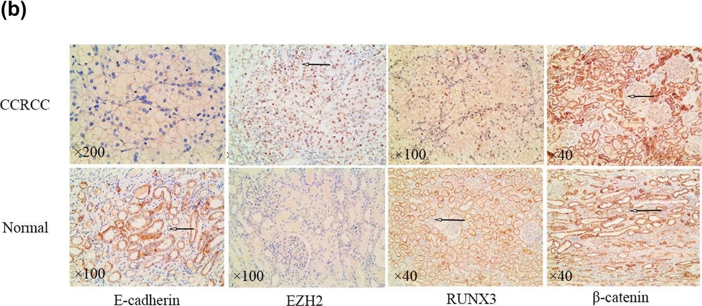 Fig.1.B showing Immunohistochemistry in a Homo sapiens (Human) sample from the publication: Antitumor activity of RUNX3: Upregulation of E-cadherin and downregulation of the epithelial-mesenchymal transition in clear-cell renal cell carcinoma.