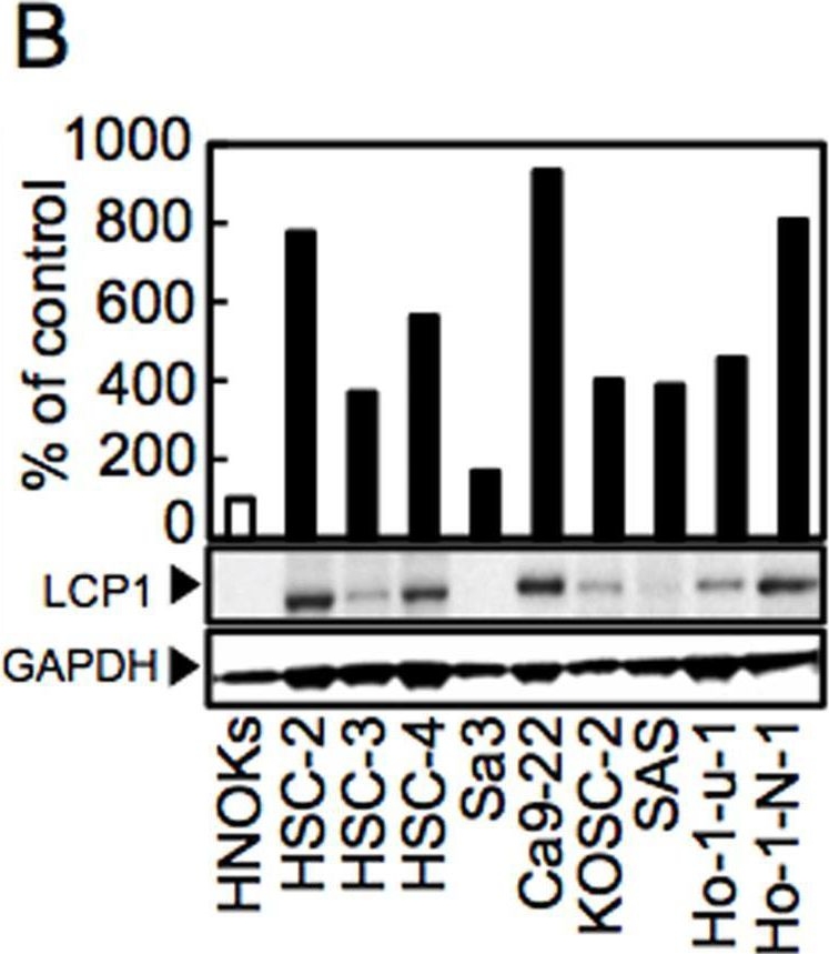 Fig.1.B showing Western Blotting from the publication: Evidence for Critical Role of Lymphocyte Cytosolic Protein 1 in Oral Cancer.