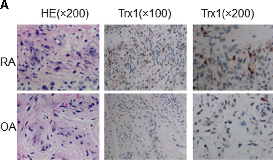 Fig.1.A showing Immunohistochemistry in a Homo sapiens (Human) sample from the publication: Thioredoxin 1 is associated with the proliferation and apoptosis of rheumatoid arthritis fibroblast-like synoviocytes.