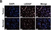 Fig.3.B showing Immunocytochemistry-immunofluorescence in a Homo sapiens (Human) sample from the publication: LEDGF Binds H3R17me2a Promoting De Novo Nucleotide Biosynthesis in SETD2 Mutant Clear Cell Renal Cell Carcinoma.