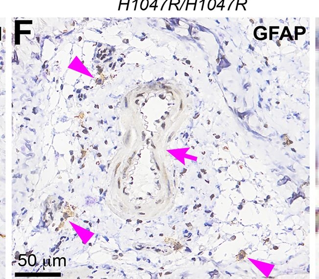 Fig.7.F showing Immunohistochemistry from the publication: Trp53 loss drives the neoplastic transformation of Pik3caH1047R-induced vascular malformation in a mouse model.