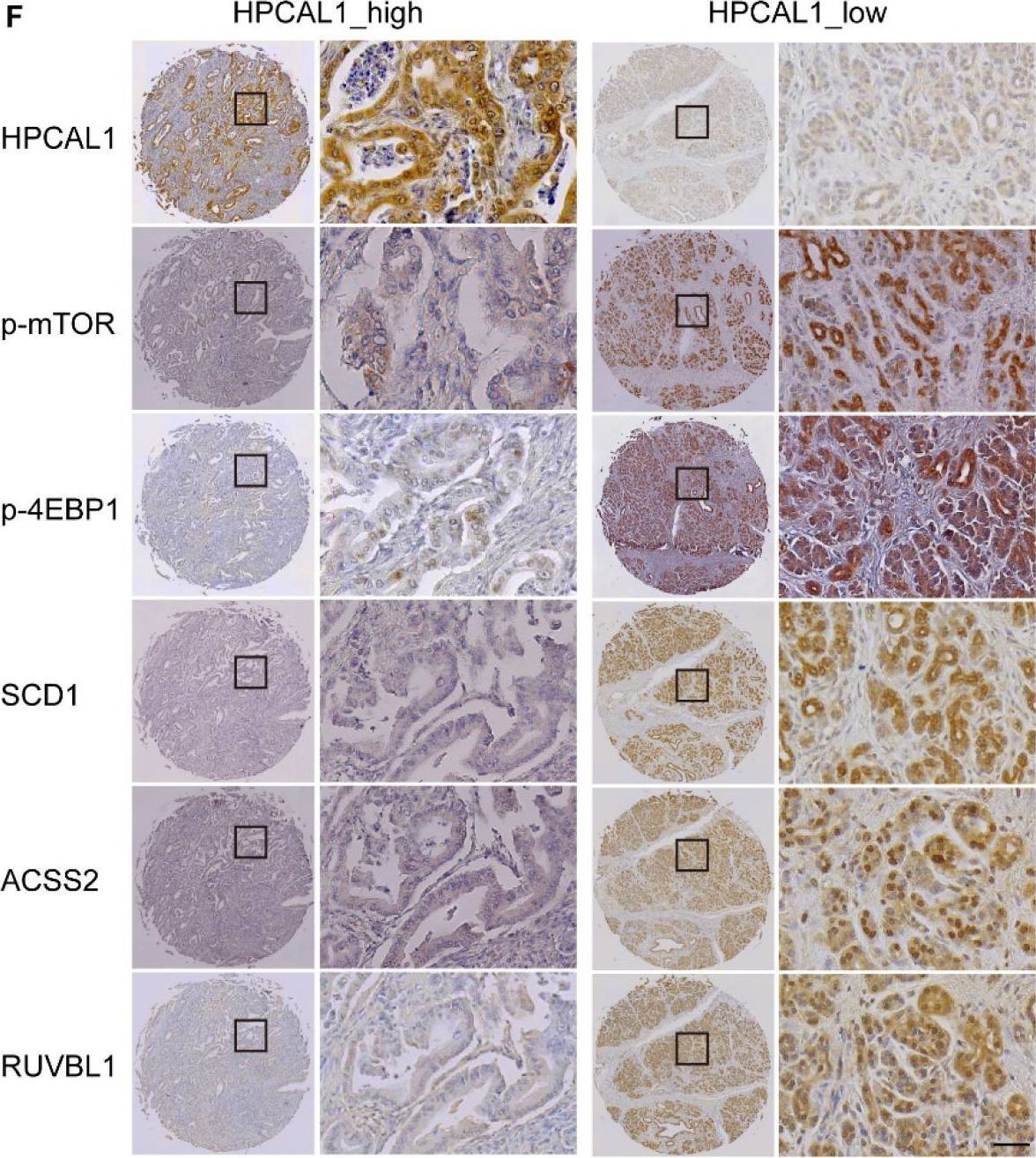 Fig.4.F showing Immunohistochemistry in a Homo sapiens (Human) sample from the publication: Hippocalcin-Like 1 blunts liver lipid metabolism to suppress tumorigenesis via directly targeting RUVBL1-mTOR signaling.