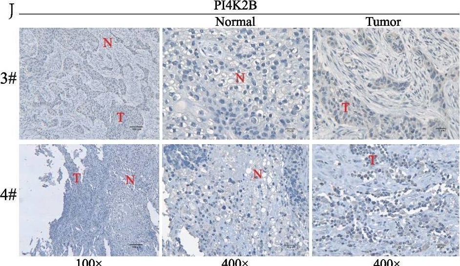 Fig.3.J showing Immunohistochemistry from the publication: The identification of a two-gene prognostic model based on cisplatin resistance-related ceRNA network in small cell lung cancer.