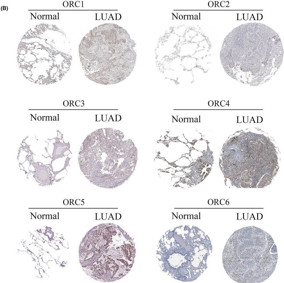 Fig.2.B showing Immunohistochemistry from the publication: Systemic analysis of the DNA replication regulator origin recognition complex in lung adenocarcinomas identifies prognostic and expression significance.