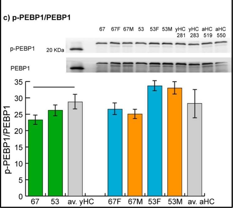 Fig.3.C showing Western Blotting in a Homo sapiens (Human) sample from the publication: Changes of RAS Pathway Phosphorylation in Lymphoblastoid Cell Lines from Noonan Syndrome Patients Carrying Hypomorphic Variants in Two NS Genes.
