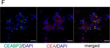 Fig.5.F showing Immunohistochemistry-immunofluorescence in a Homo sapiens (Human) sample from the publication: Targeted Inhibition of Colorectal Carcinoma Using a Designed CEA-Binding Protein to Deliver p53 Protein and TCF/LEF Transcription Factor Decoy DNA.