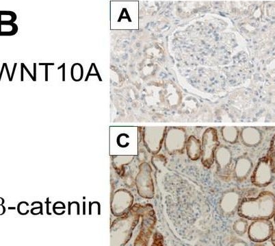 Fig.2.B showing Immunohistochemistry from the publication: WNT10A plays an oncogenic role in renal cell carcinoma by activating WNT/β-catenin pathway.