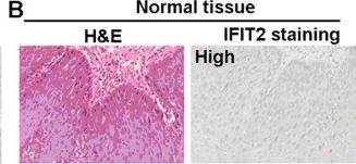 Fig.2.B showing Immunohistochemistry in a Homo sapiens (Human) sample from the publication: STAT1/IFIT2 signaling pathway is involved in PD-L1-mediated epithelial-to-mesenchymal transition in human esophageal cancer.