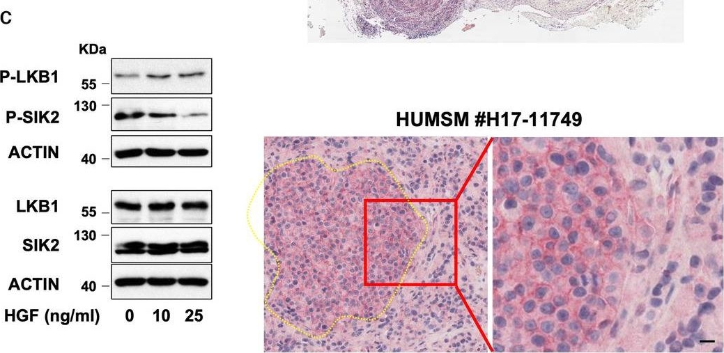 Fig.2.C showing Immunohistochemistry in a Homo sapiens (Human) sample from the publication: LKB1-SIK2 loss drives uveal melanoma proliferation and hypersensitivity to SLC8A1 and ROS inhibition.