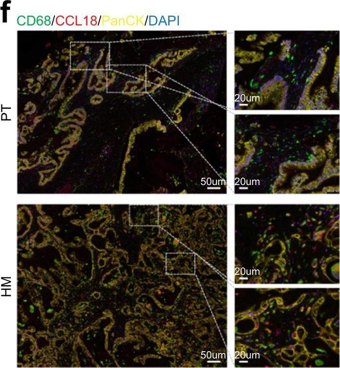 Fig.5.F showing Immunohistochemistry-immunofluorescence in a Homo sapiens (Human) sample from the publication: Single cell transcriptomic analyses implicate an immunosuppressive tumor microenvironment in pancreatic cancer liver metastasis.