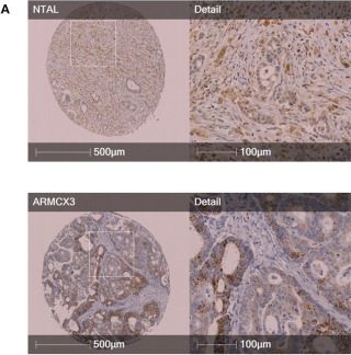 Fig.2.A showing Immunohistochemistry in a Homo sapiens (Human) sample from the publication: Senescence-Associated Molecules and Tumor-Immune-Interactions as Prognostic Biomarkers in Colorectal Cancer.