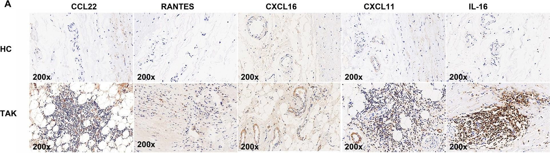 Fig.2.A showing Immunohistochemistry in a Homo sapiens (Human) sample from the publication: A comprehensive profile of chemokines in the peripheral blood and vascular tissue of patients with Takayasu arteritis.