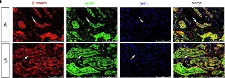 Fig.10.H showing Immunohistochemistry-immunofluorescence in a Homo sapiens (Human) sample from the publication: β-catenin-inhibited Sumoylation modification of LKB1 and fatty acid metabolism is critical in renal fibrosis.