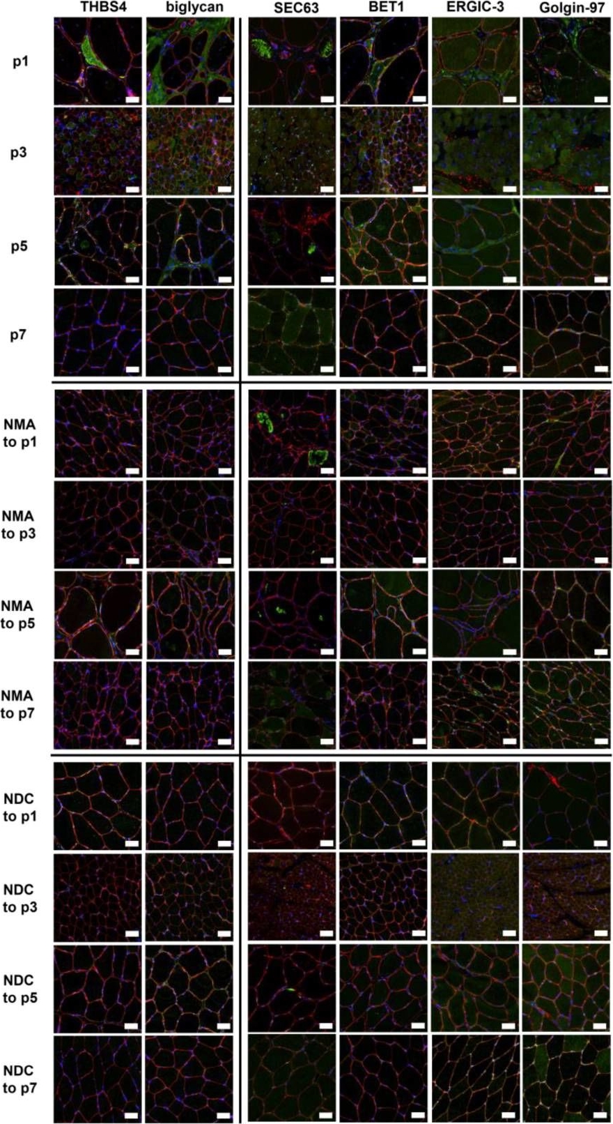 Fig.6.A showing Immunohistochemistry in a Homo sapiens (Human) sample from the publication: Microscopic and Biochemical Hallmarks of BICD2-Associated Muscle Pathology toward the Evaluation of Novel Variants.