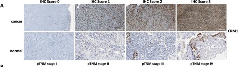 Fig.2.A showing Immunohistochemistry in a Homo sapiens (Human) sample from the publication: CRM1 expression: association with high prognostic value in laryngeal cancer.