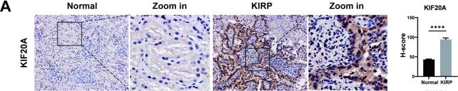 Fig.8.A showing Immunohistochemistry in a Homo sapiens (Human) sample from the publication: Metabolic heterogeneity and survival outcomes in papillary renal cell carcinoma: insights from multi-datasets and machine learning analyses.