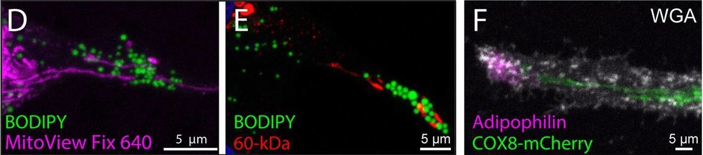 Fig.2.D showing Immunohistochemistry-immunofluorescence in a Homo sapiens (Human) sample from the publication: Extracellular lipidosomes containing lipid droplets and mitochondria are released during melanoma cell division.