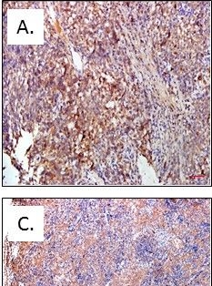 Fig.1.A showing Immunohistochemistry in a Homo sapiens (Human) sample from the publication: Survival analyses correlate stanniocalcin 2 overexpression to poor prognosis of nasopharyngeal carcinomas.