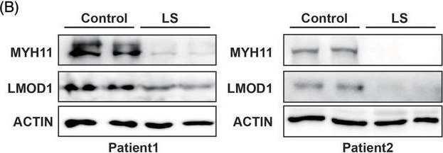 Fig.2.B showing Western Blotting in a Homo sapiens (Human) sample from the publication: Alteration of gene expression related to vulvar smooth muscle, extracellular matrix and innervation in vulvar lichen sclerosus: A pilot study.