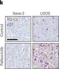 Fig.1.K showing Immunohistochemistry in a Homo sapiens (Human) sample from the publication: The efficacy of chemotherapy is limited by intratumoral senescent cells expressing PD-L2.