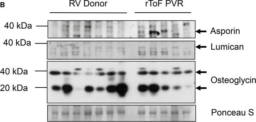 Fig.7.B showing Western Blotting in a Homo sapiens (Human) sample from the publication: Right Ventricle Has Normal Myofilament Function But Shows Perturbations in the Expression of Extracellular Matrix Genes in Patients With Tetralogy of Fallot Undergoing Pulmonary Valve Replacement.