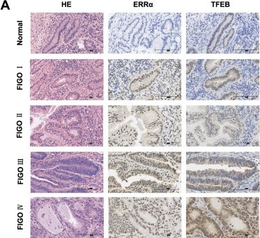 Fig.6.A showing Immunohistochemistry in a Homo sapiens (Human) sample from the publication: Lipid reprogramming induced by the TFEB-ERRα axis enhanced membrane fluidity to promote EC progression.