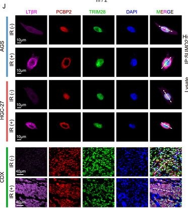 Fig.6.J showing Immunocytochemistry-immunofluorescence in a Homo sapiens (Human) sample from the publication: Radiation-Induced Tumor-Intrinsic LTβR N-Glycosylation Suppresses Pyroptosis Through TRIM28-Mediated PCBP2 SUMOylation to Promote Gastric Cancer Radioresistance.