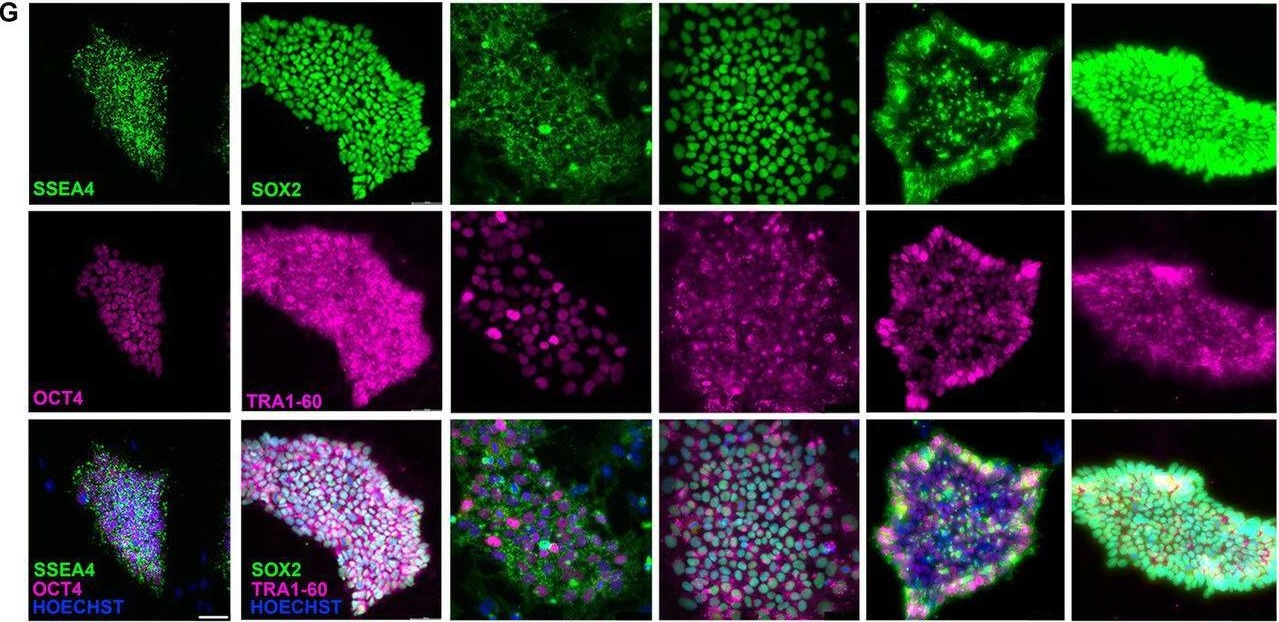 Fig.1.G showing Immunocytochemistry-immunofluorescence in a Homo sapiens (Human) sample from the publication: Modeling riboflavin transporter deficiency type 2: from iPSC-derived motoneurons to iPSC-derived astrocytes.