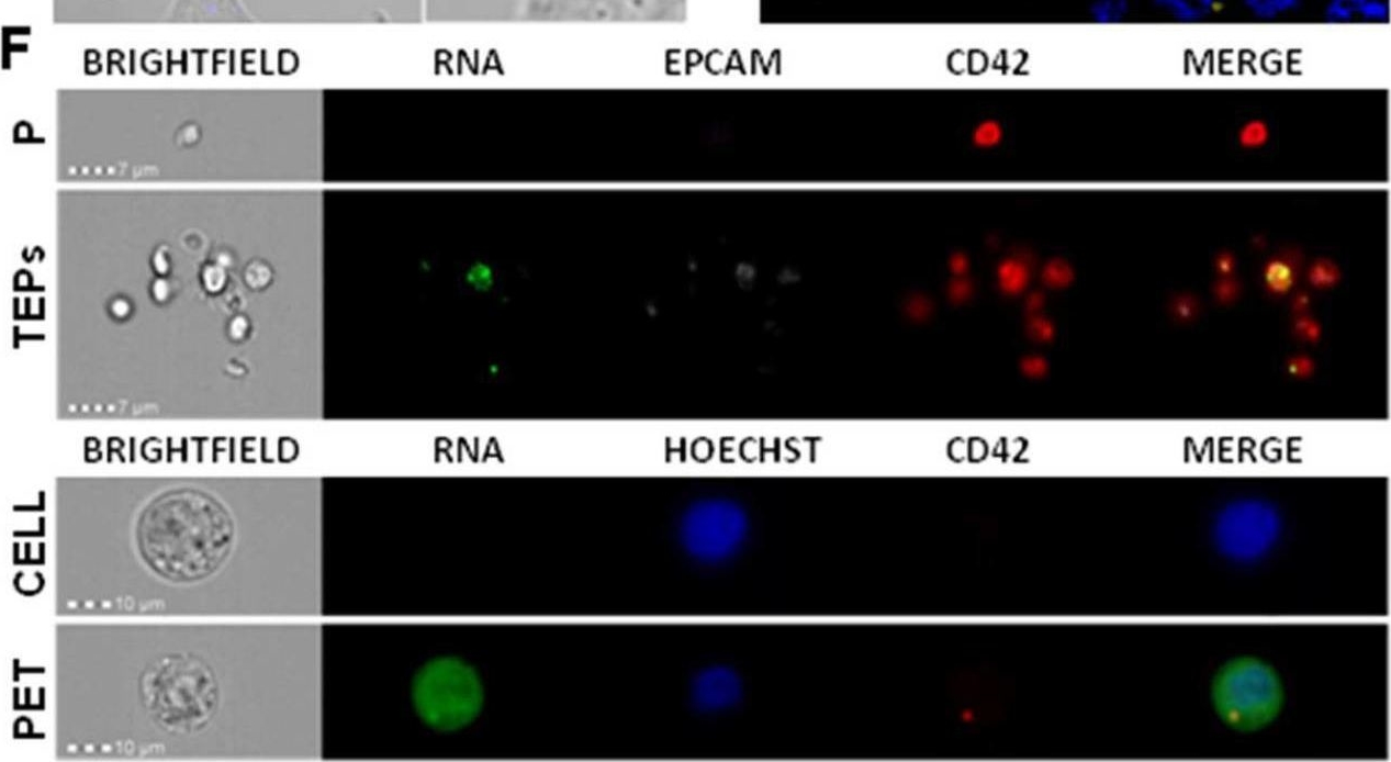 Fig.3.F showing Immunocytochemistry-immunofluorescence in a Homo sapiens (Human) sample from the publication: Exchange of cellular components between platelets and tumor cells: impact on tumor cells behavior.