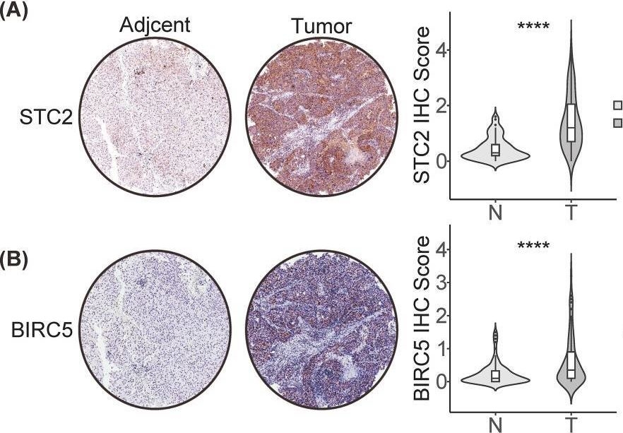 Fig.6.A showing Immunohistochemistry in a Homo sapiens (Human) sample from the publication: An immune-related signature based on molecular subtypes for predicting the prognosis and immunotherapy efficacy of hepatocellular carcinoma.