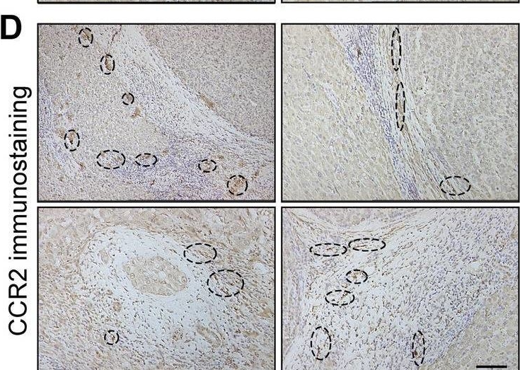 Fig.1.D showing Immunohistochemistry from the publication: Targeted blocking of CCR2 and CXCR2 improves the efficacy of transarterial chemoembolization of hepatocarcinoma.