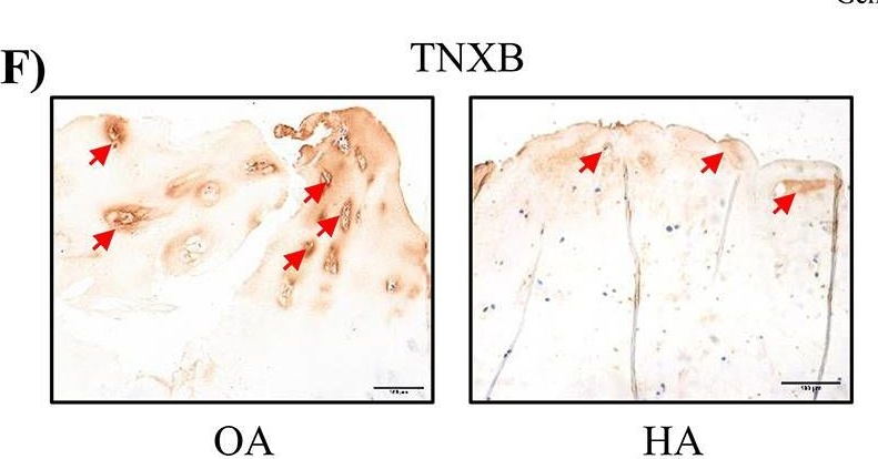 Fig.2.F showing Immunohistochemistry in a Homo sapiens (Human) sample from the publication: Aberrant methylation and expression of TNXB promote chondrocyte apoptosis and extracullar matrix degradation in hemophilic arthropathy via AKT signaling.