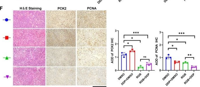 Fig.8.F showing Immunohistochemistry in a Homo sapiens (Human) sample from the publication: PCK2 Inhibition Reverses Cisplatin Resistance of Non-Small Cell Lung Cancer by Triggering Ferroptosis.