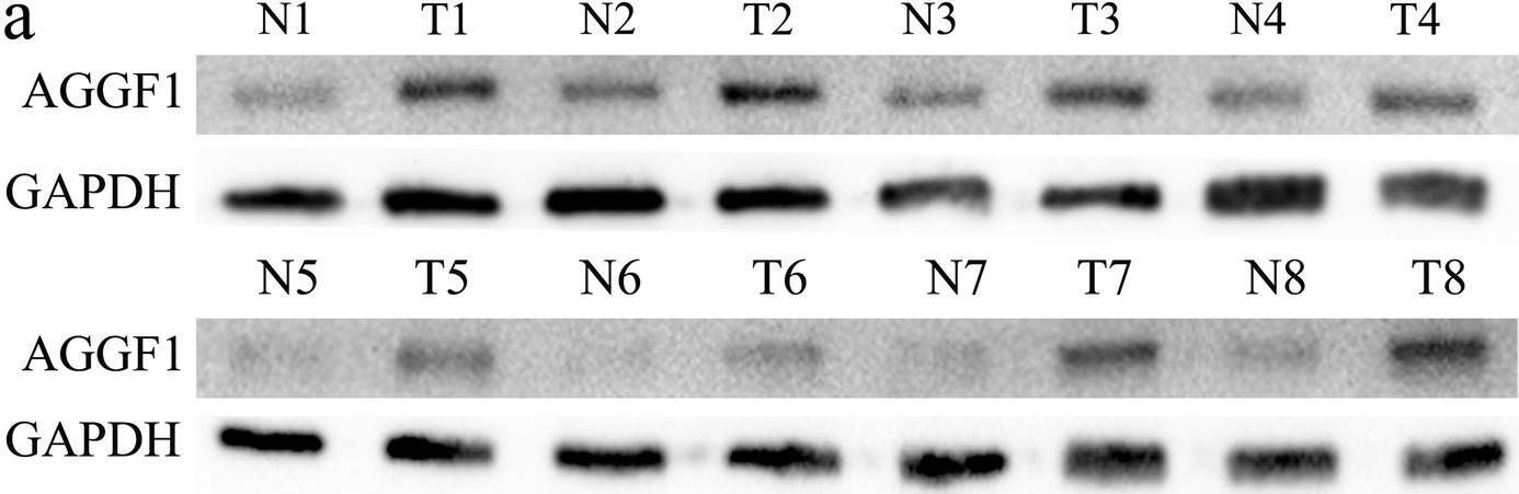 Fig.1.A showing Western Blotting in a Homo sapiens (Human) sample from the publication: Elevated expression of AGGF1 predicts poor prognosis and promotes the metastasis of colorectal cancer.