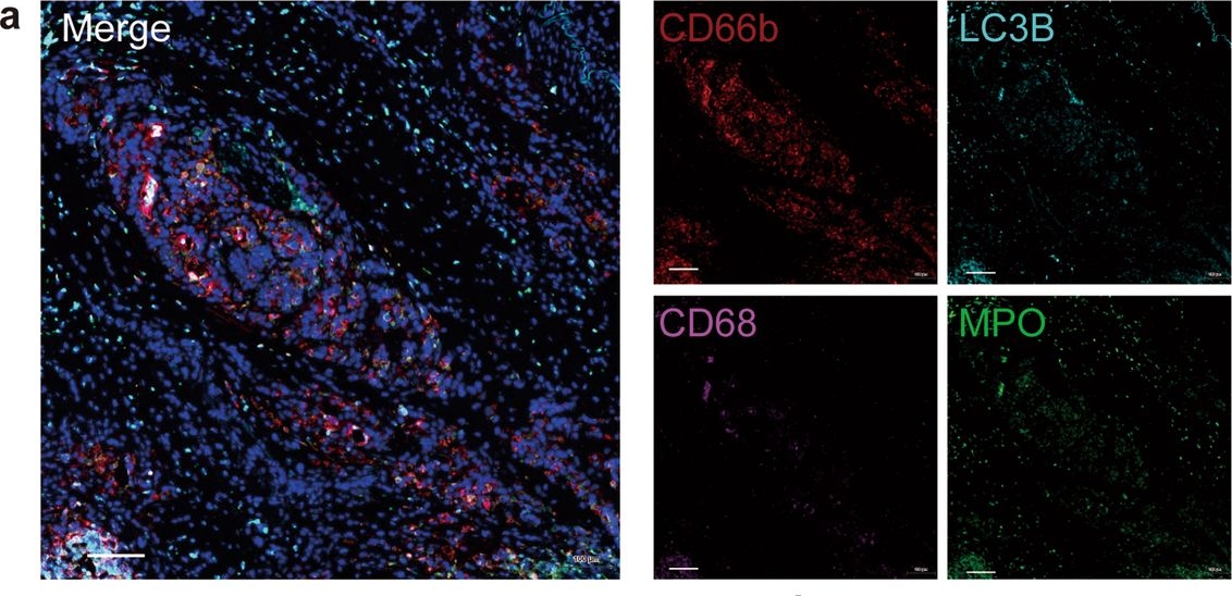 Fig.3.A showing Immunohistochemistry-immunofluorescence in a Homo sapiens (Human) sample from the publication: Multiomics integration reveals NETosis heterogeneity and TLR2 as a prognostic biomarker in pancreatic cancer.