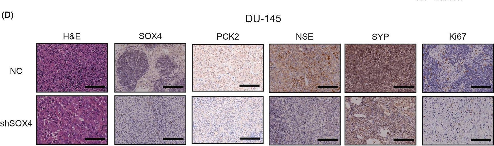 Fig.7.D showing Immunohistochemistry in a Homo sapiens (Human) sample from the publication: Targeting SOX4/PCK2 signaling suppresses neuroendocrine trans-differentiation of castration-resistant prostate cancer.