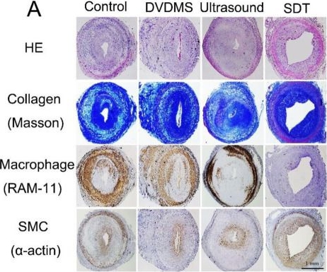 Fig.1.A showing Immunohistochemistry from the publication: Sonodynamic therapy suppresses matrix collagen degradation in vulnerable atherosclerotic plaque by modulating caspase 3 - PEDF/HIF-1α - MMP-2/MMP-9 signaling in macrophages.