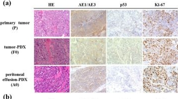Fig.2.A showing Immunohistochemistry in a Homo sapiens (Human) sample from the publication: Creation and Validation of Patient-Derived Cancer Model Using Peritoneal and Pleural Effusion in Patients with Advanced Ovarian Cancer: An Early Experience.
