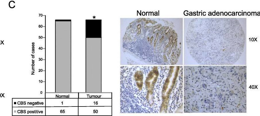 Fig.2.C showing Immunohistochemistry from the publication: Highly recurrent CBS epimutations in gastric cancer CpG island methylator phenotypes and inflammation.