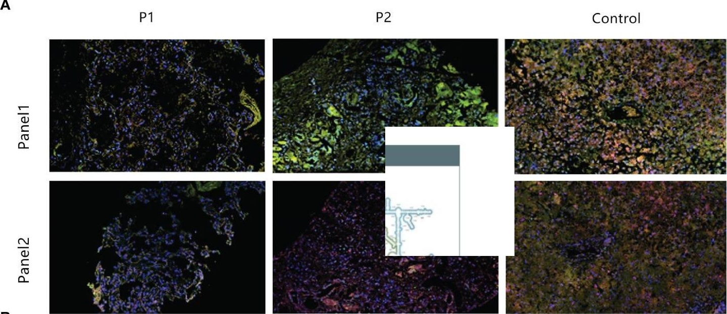 Fig.3.A showing Immunohistochemistry-immunofluorescence in a Homo sapiens (Human) sample from the publication: Pathoimmunological analyses of fatal E11 infection in premature infants.