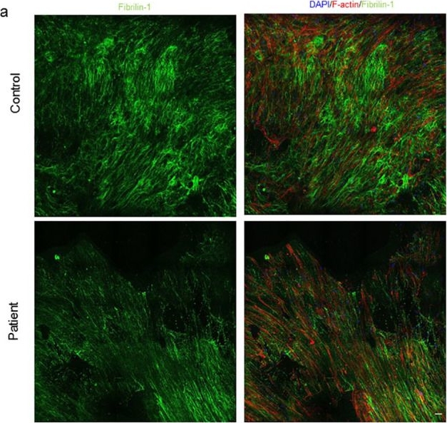 Fig.4.A showing Immunohistochemistry-immunofluorescence in a Homo sapiens (Human) sample from the publication: Patient-Specific 3-Dimensional Model of Smooth Muscle Cell and Extracellular Matrix Dysfunction for the Study of Aortic Aneurysms.