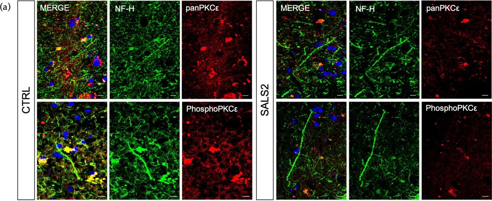 Fig.4.A showing Immunohistochemistry-immunofluorescence in a Homo sapiens (Human) sample from the publication: The ε-Isozyme of Protein Kinase C (PKCε) Is Impaired in ALS Motor Cortex and Its Pulse Activation by Bryostatin-1 Produces Long Term Survival in Degenerating SOD1-G93A Motor Neuron-like Cells.