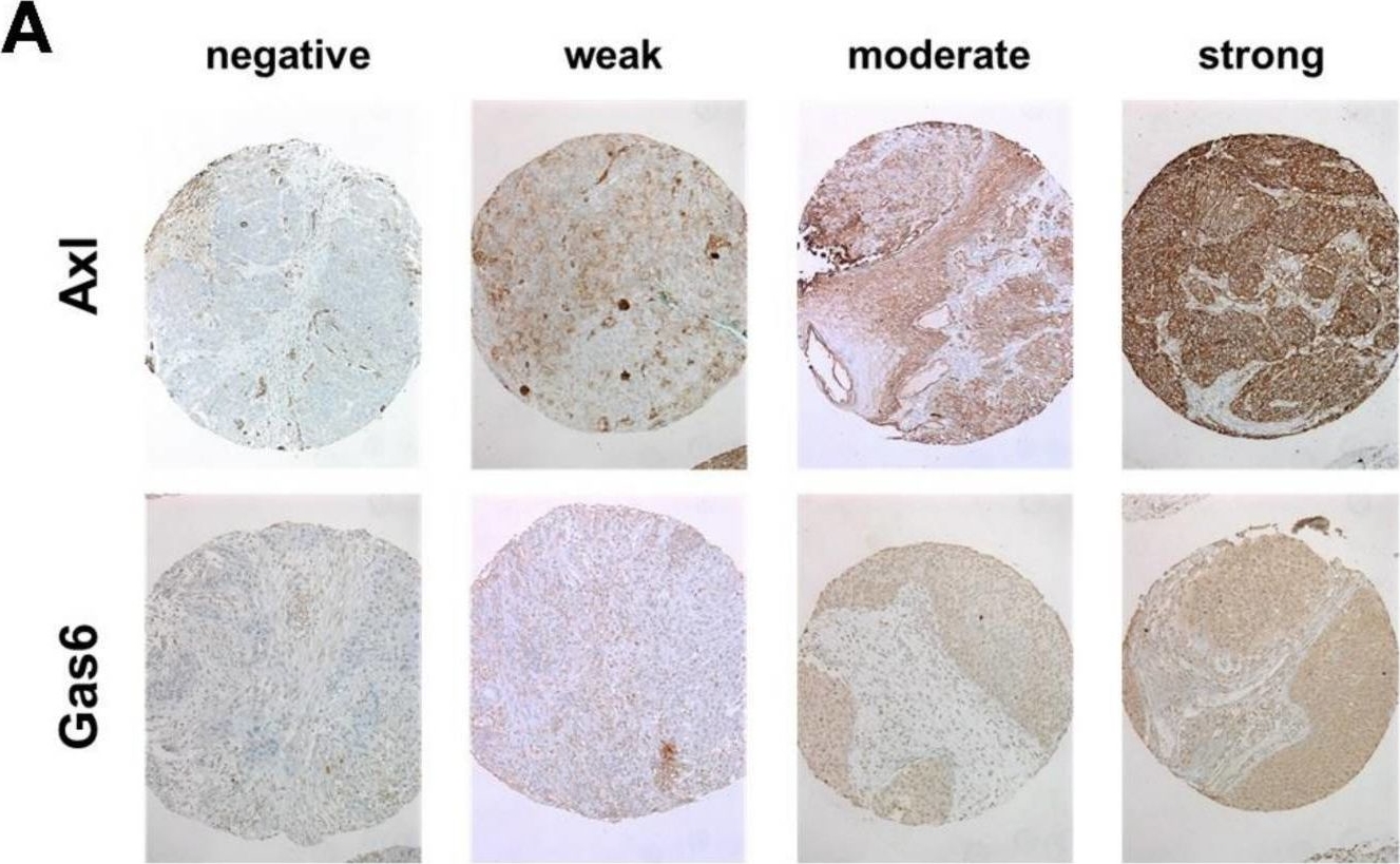 Fig.1.A showing Immunohistochemistry in a Homo sapiens (Human) sample from the publication: Tissue Microarray Analyses Suggest Axl as a Predictive Biomarker in HPV-Negative Head and Neck Cancer.