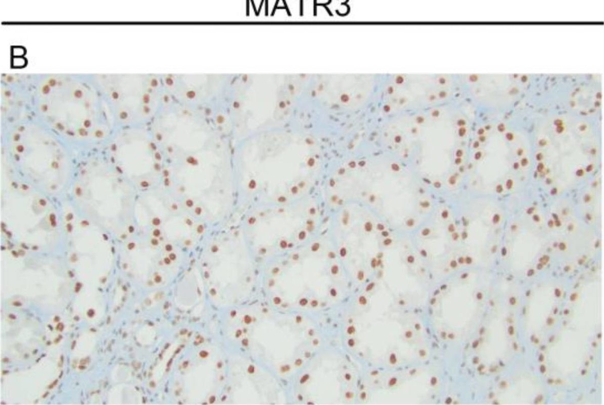 Fig.1.B showing Immunohistochemistry from the publication: Low Expression of MATR3 Is Associated with Poor Survival in Clear Cell Renal Cell Carcinoma.