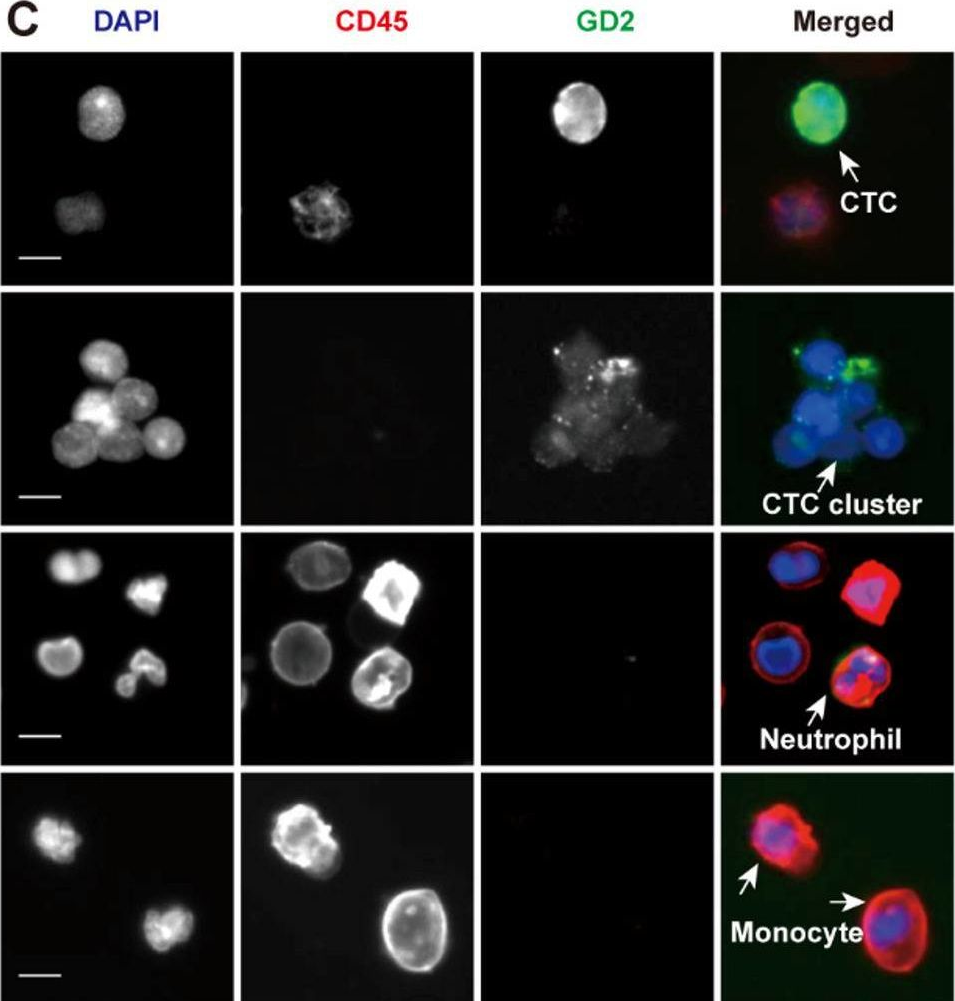 Fig.1.C showing Immunocytochemistry-immunofluorescence from the publication: Circulating tumor cells and clusters as liquid biomarkers for the diagnosis and prognosis of neuroblastoma.