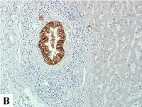 Fig.1.B showing Immunohistochemistry in a Homo sapiens (Human) sample from the publication: Expression of hypoxic marker carbonic anhydrase IX predicts poor prognosis in resectable hepatocellular carcinoma.