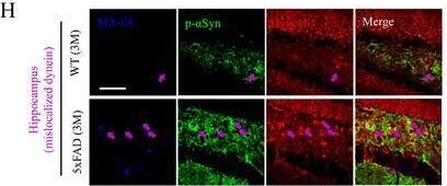 Fig.5.H showing Immunohistochemistry-immunofluorescence in a Homo sapiens (Human) sample from the publication: Dynein-Dependent Endo-Lysosomal Degradation Drives Lewy Body Disorders Accompanied by Aβ Pathology.