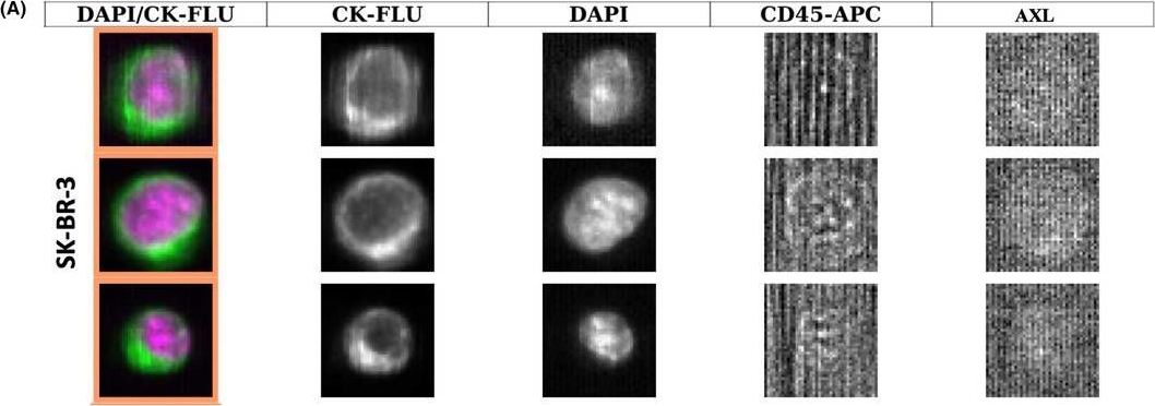 Fig.2.A showing Immunocytochemistry-immunofluorescence in a Homo sapiens (Human) sample from the publication: First evidence of AXL expression on circulating tumor cells in metastatic breast cancer patients: A proof-of-concept study.